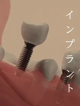インプラント